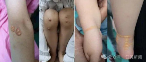 策略联盟 别忽视孩子身上这种“小疙瘩”! 5岁男孩确诊已是晚期
